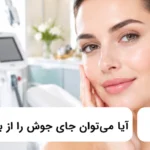 آیا می توان جای جوش را از بین برد؟✅【سال1405】⭐