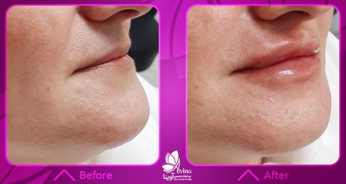 تزریق ژل چگونه انجام می شود؟