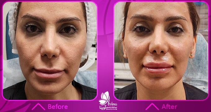 تزریق ژل چیست؟