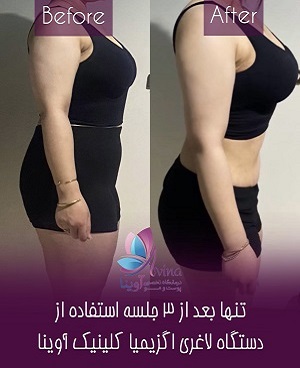 نکاتی در مورد عمل لیپوماتیک در شهر کرج