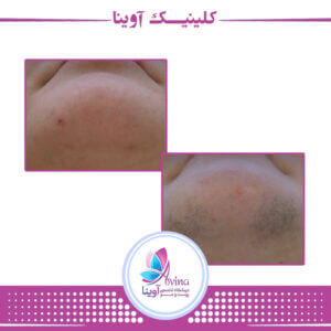دستگاههای لیزر مورداستفاده در کلینیک آوینا