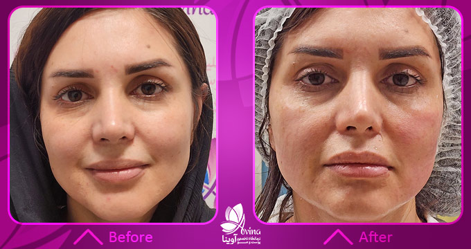 نمونه کار هایفوتراپی در کلینیک آوینا