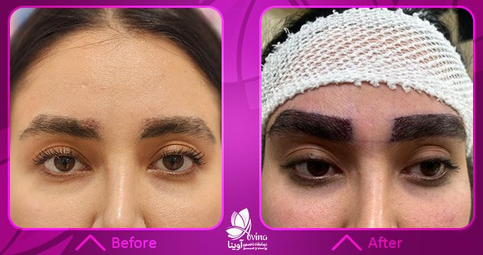 نمونه کار کاشت ابرو در کلینیک آوینا