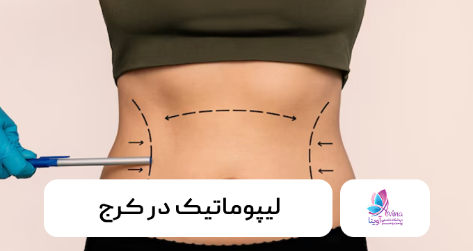 لیپوماتیک در کرج