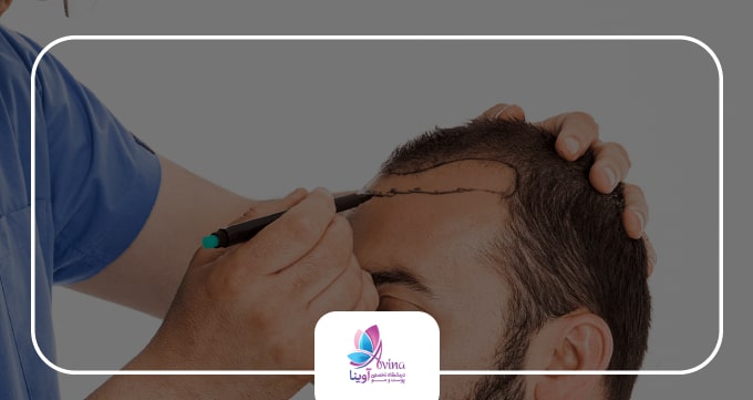 کاشت مو چیست ؟
