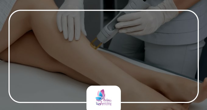 عوامل تاثیرگذار بر روی قیمت لیزر موهای زائد