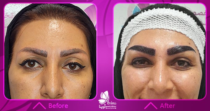 روشهای انجام کاشت ابرو