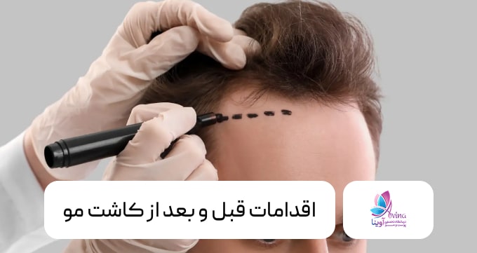 اقدامات قبل و بعد از کاشت مو