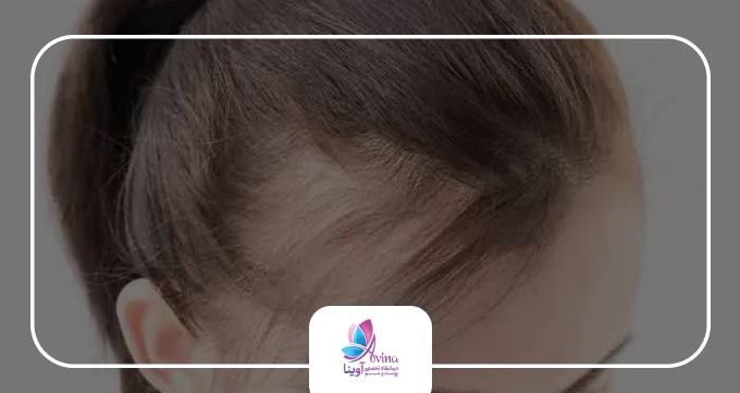 آیا خانمها هم میتوانند از کاشت مو بهره ببرند؟