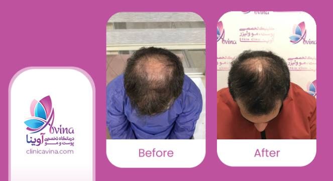 چگونگی انجام کاشت مو در بانوان