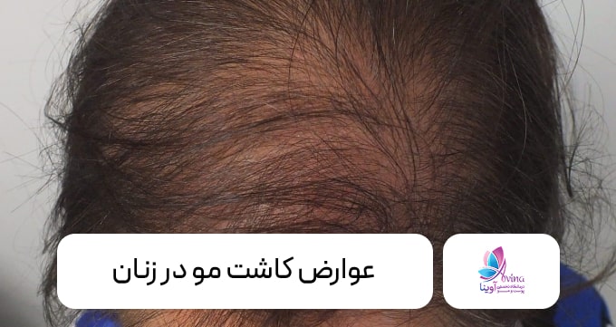 عوارض کاشت مو در زنان