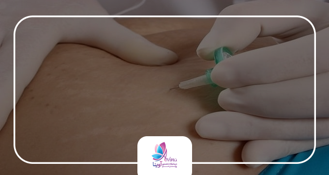 چرا کربوکسیتراپی در کلینیک آوینا؟ ترکیبی از تکنولوژی پیشرفته و تخصص پزشکی