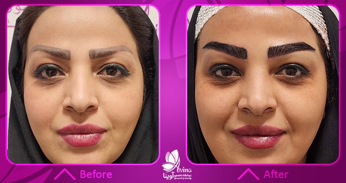 قبل و بعد از کاشت ابرو به روش میکروگرافت