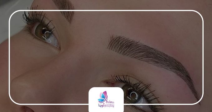 کاشت ابرو چیست ؟