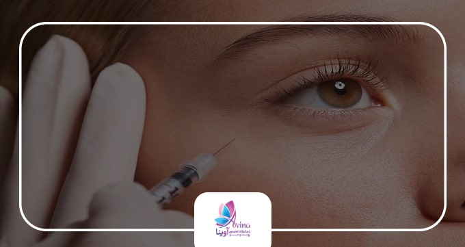 تزریق ژل زیر چشم چیست؟