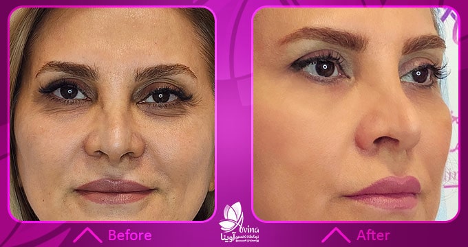 4 تاثیر شگفت انگیز تزریق ژل زیر چشم