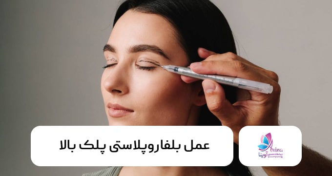 عمل بلفاروپلاستی پلک بالا