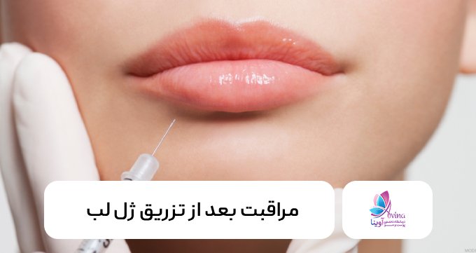 مراقبت بعد از تزریق ژل لب