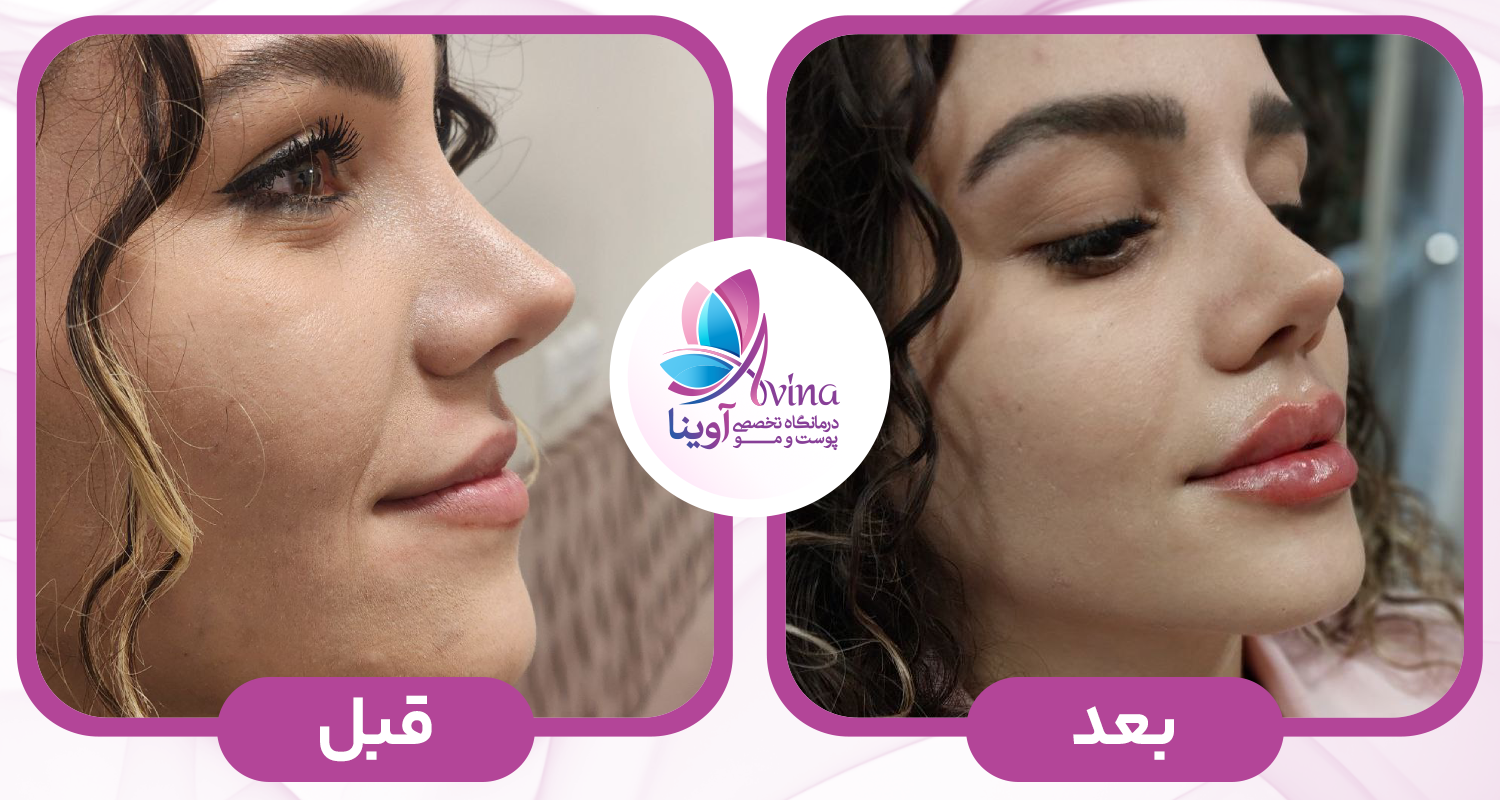 نمونه کار تزریق ژل در کلینیک آوینا