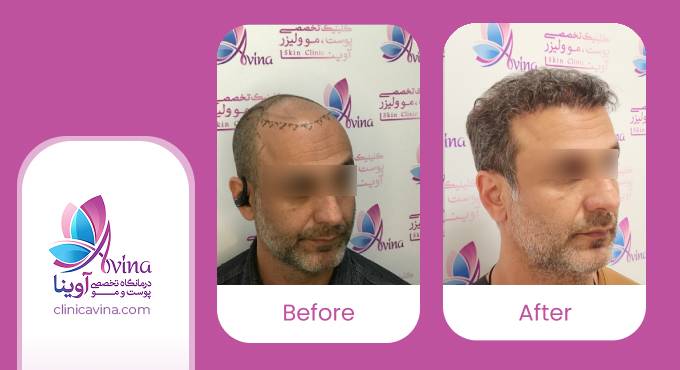 1نمونه-کار-کاشت-مو-در-کلینیک-آوینا