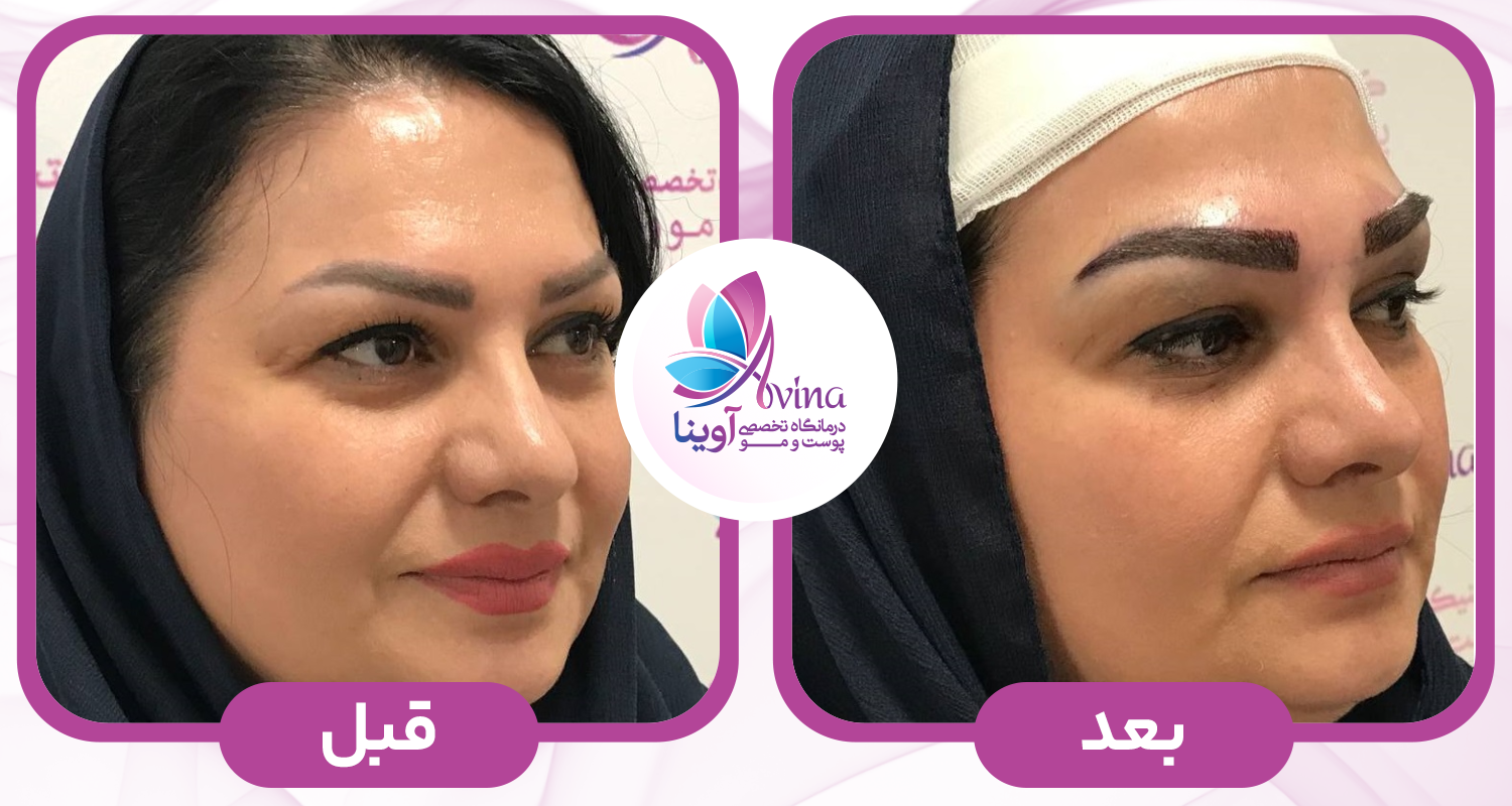 کاشت ابرو-در-کلینیک-آوینا