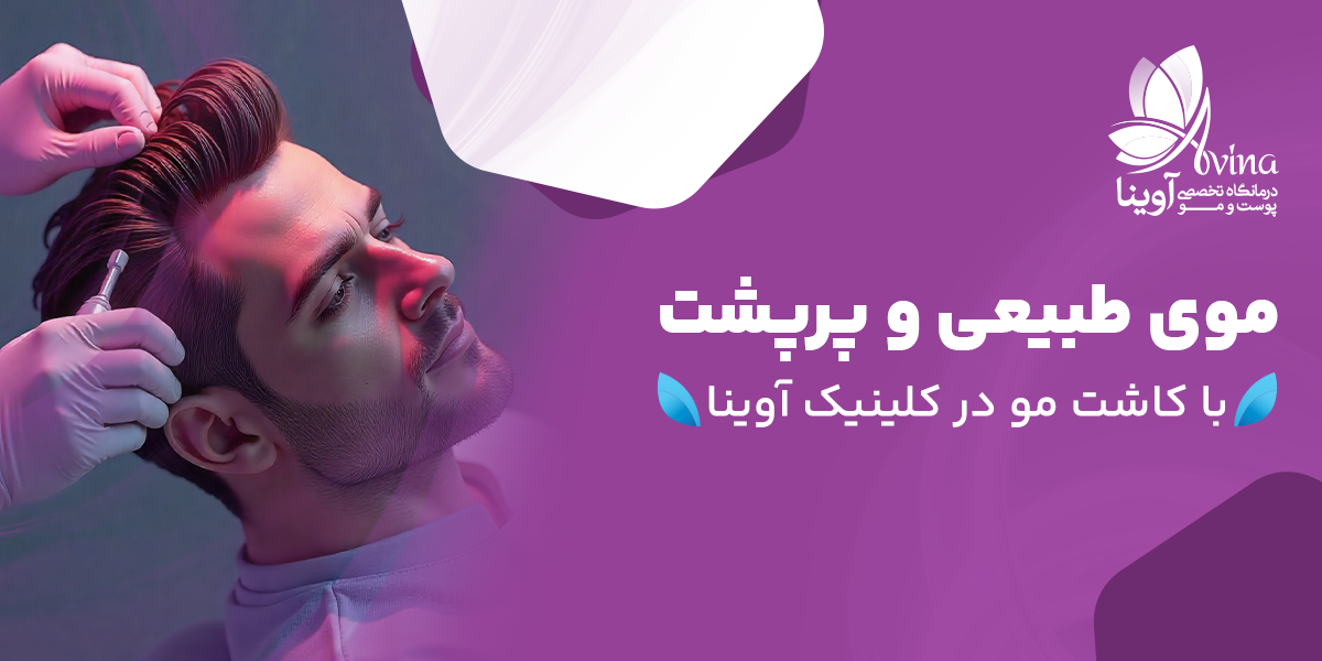 کاشت موی طبیعی در کلینیک آوینا