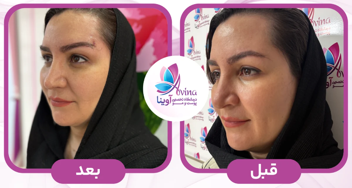 قبل و بعد از لیفت با نخ در کلینیک آوینا