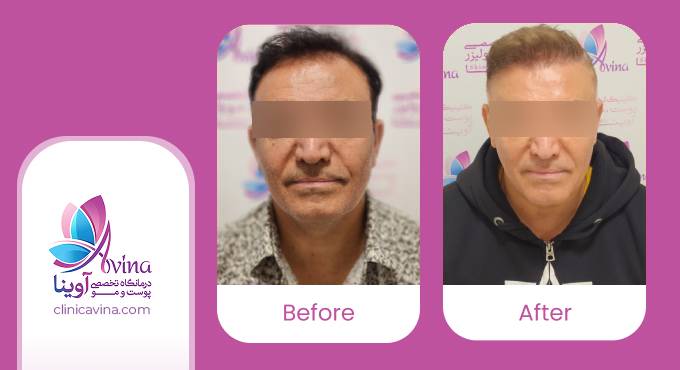 نمونه-کار-کاشت-مو-در-کلینیک-آوینا63