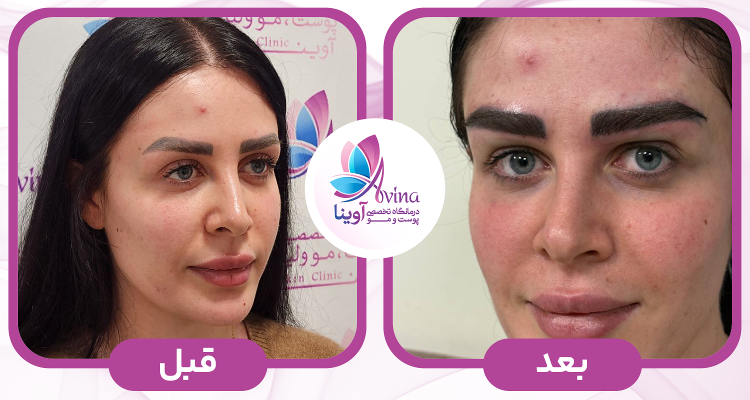 کاشت-ابرو-آوینا