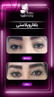 بلفاروپلاستی کلینیک آوینا