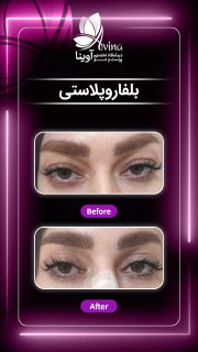 بلفاروپلاستی