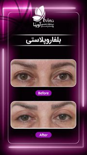 بلفاروپلاستی کلینیک آوینا
