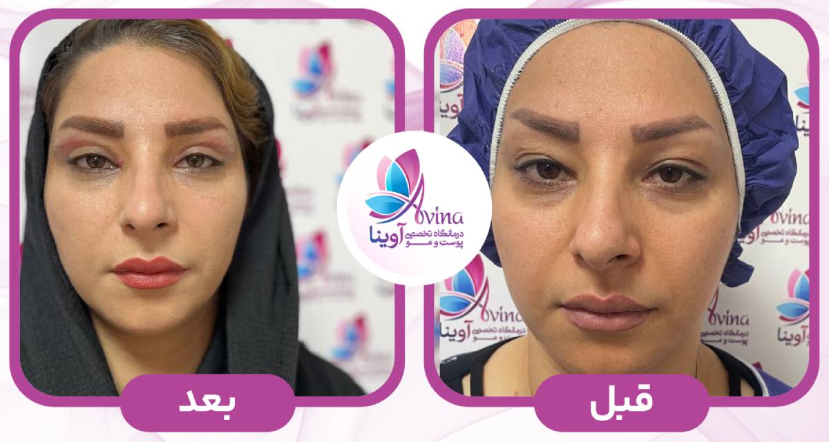 نمونه کار بلفاروپلاستی در کلینیک آوینا