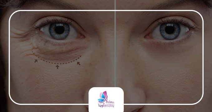 بلفاروپلاستی چیست؟