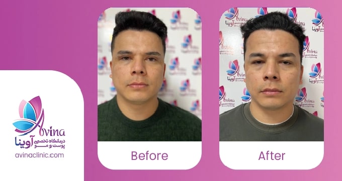 مراحل عمل بلفاروپلاستی