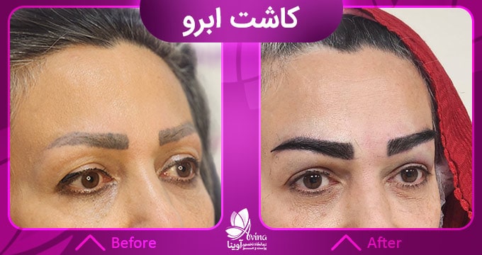 کاشت ابرو به روش FUT چگونه انجام میشود؟