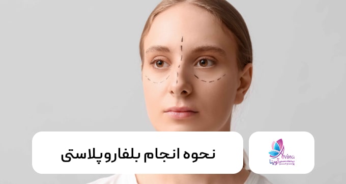 نحوه انجام بلفاروپلاستی