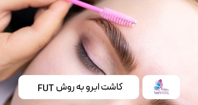 کاشت ابرو به روش FUT