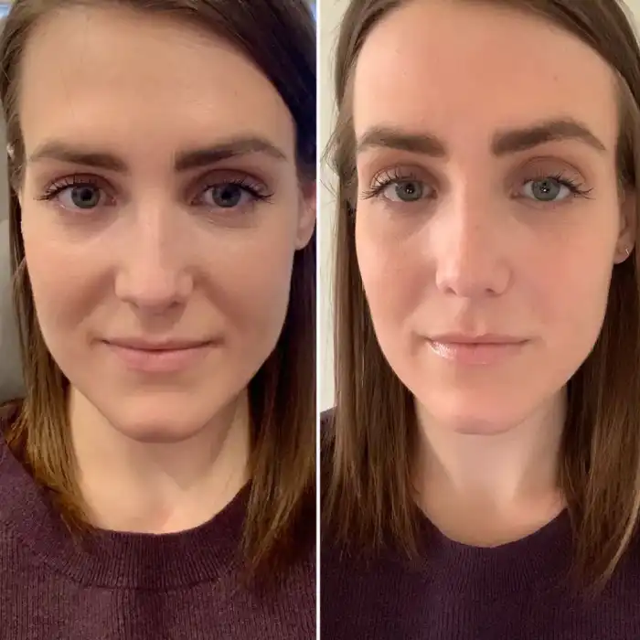 فواید مراجعه به بهترین مرکز فیلر بینی در گوهردشت