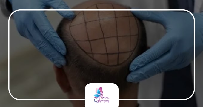 راه های نوین کاشت مو در بهترین کلینیک کاشت مو در گوهردشت