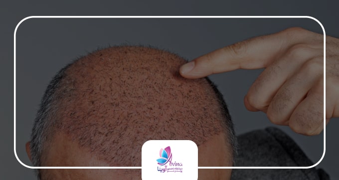 خدمات بهترین کلینیک کاشت مو در گوهردشت