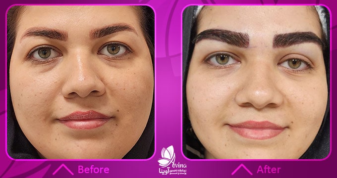 عوارض احتمالی کاشت ابرو