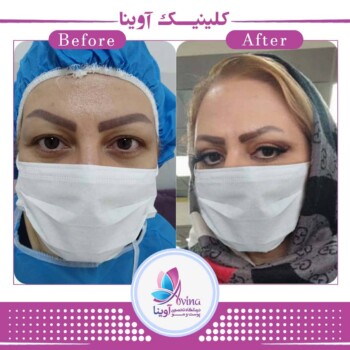 بلفاروپلاستی کلینیک آوینا