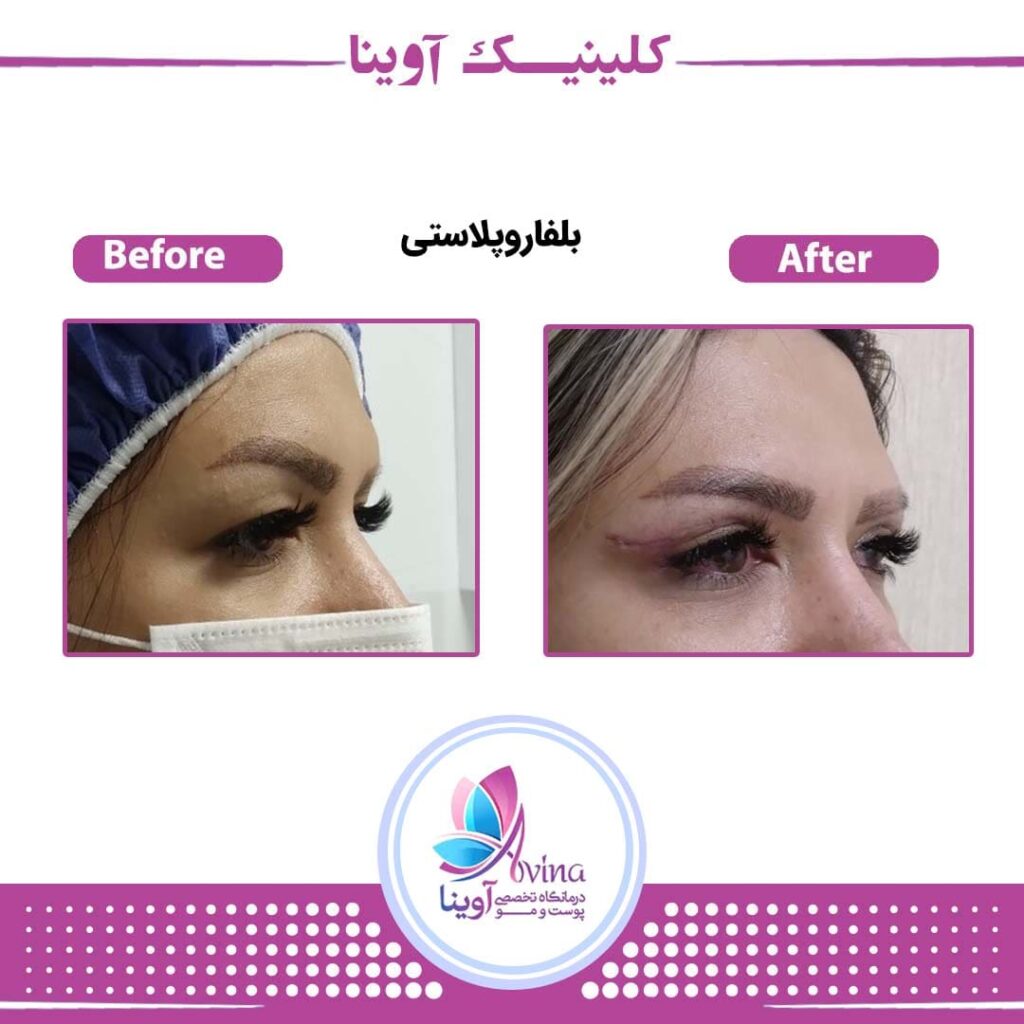 بلفاروپلاستی کلینیک آوینا