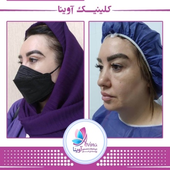 بلفاروپلاستی کلینیک آوینا