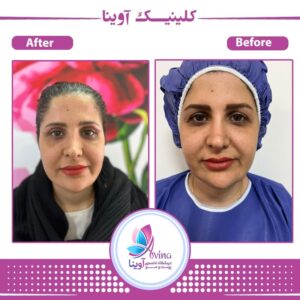 بلفاروپلاستی کلینیک آوینا