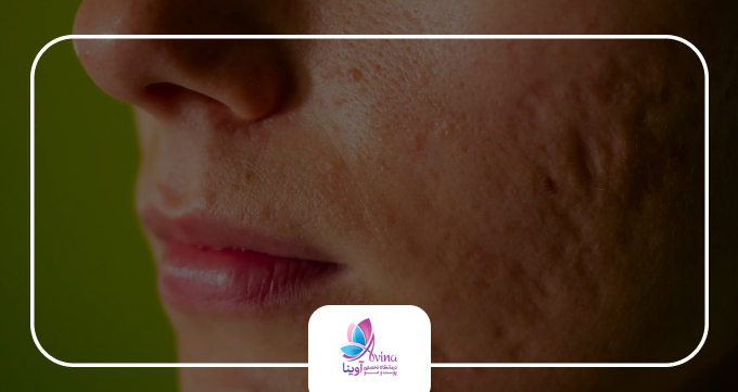 روش دوم: ماسک عسل و دارچین برای کاهش جای جوش