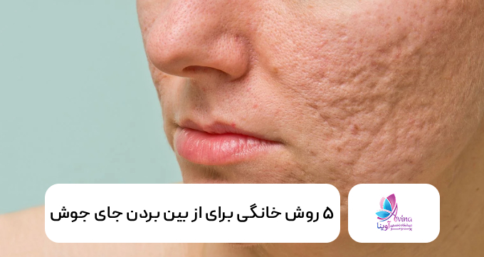 5 روش خانگی برای از بین بردن جای جوش