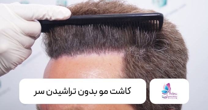 کاشت مو بدون تراشیدن سر