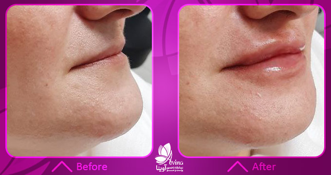 روشهای استفاده از ژلهای تأیید شده در پزشکی و زیبایی